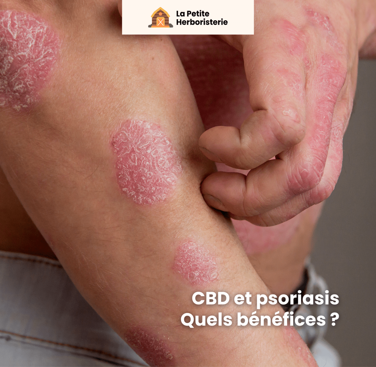 CBD et psoriasis quels bénéfices
